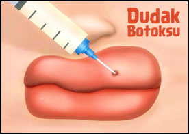 Dudak Botoksu 2
